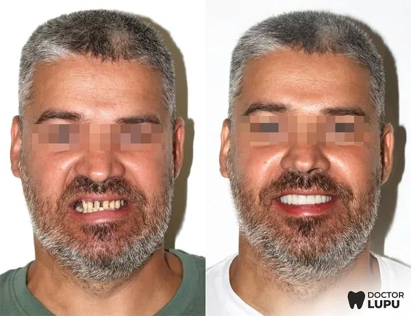 Cazul 01 - Înainte și după tratament