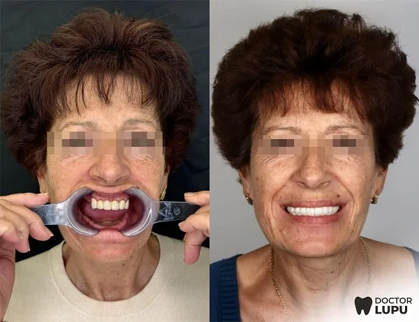 Cazul 05 - Înainte și după tratament