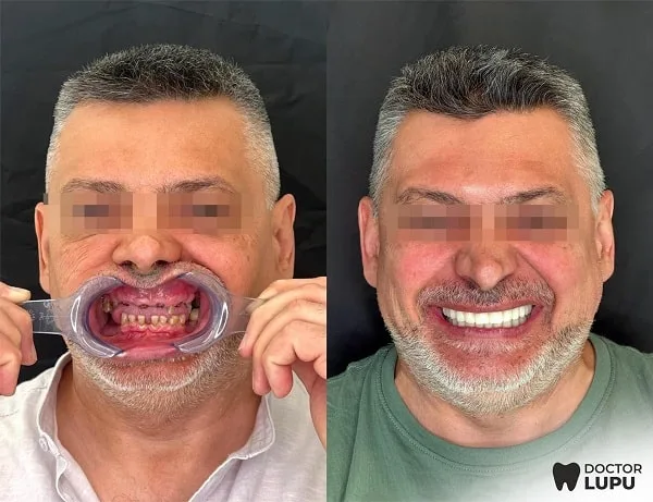 Cazul 03 - Înainte și după tratament