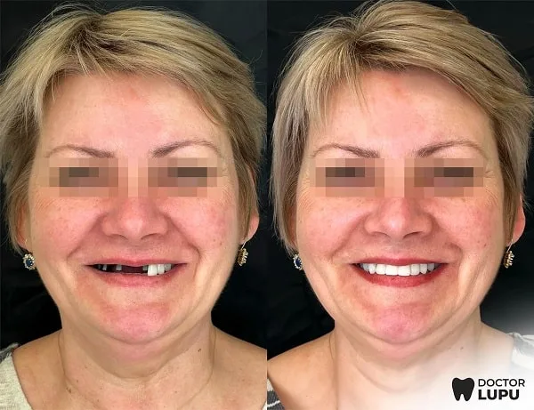 Cazul 04 - Înainte și după tratament