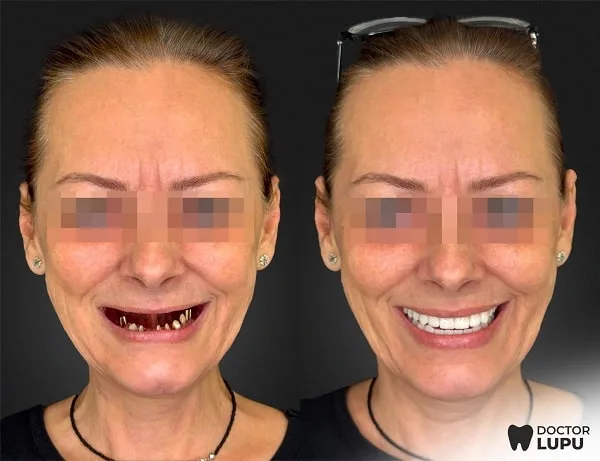 Cazul 02 - Înainte și după tratament