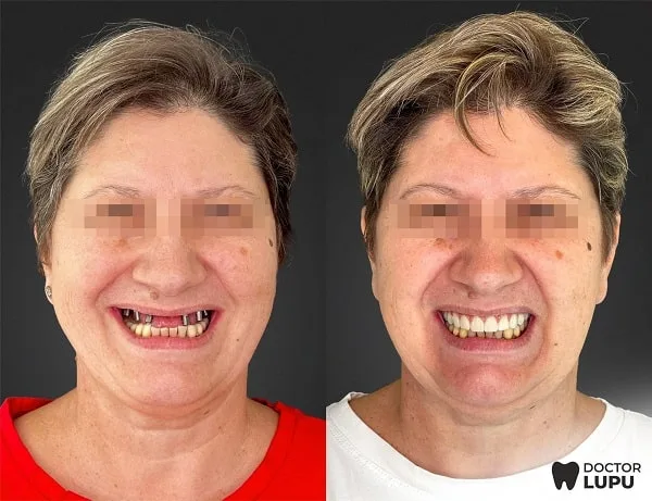 Cazul 06 - Înainte și după tratament