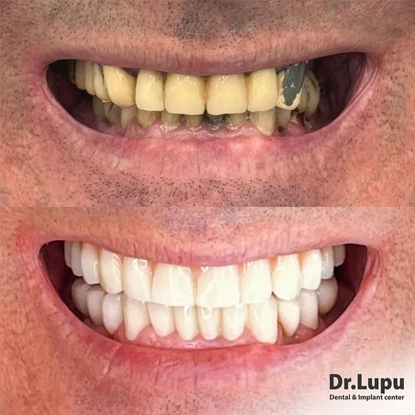 Cazul 28 - Înainte și după tratament