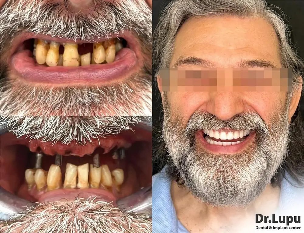 Caz clinic reabilitare orală totală cu 12 implanturi după parodontoză avansată