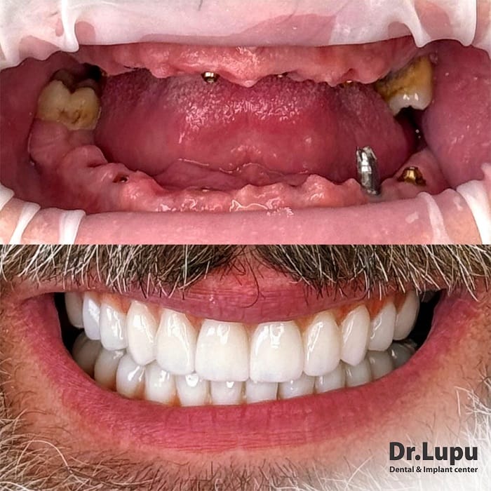 Caz complex de implant dentar (Sinus lift, adiții osoase și 6 implanturi)