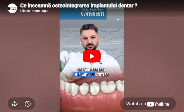 Ce înseamnă osteointegrarea implantului dentar?