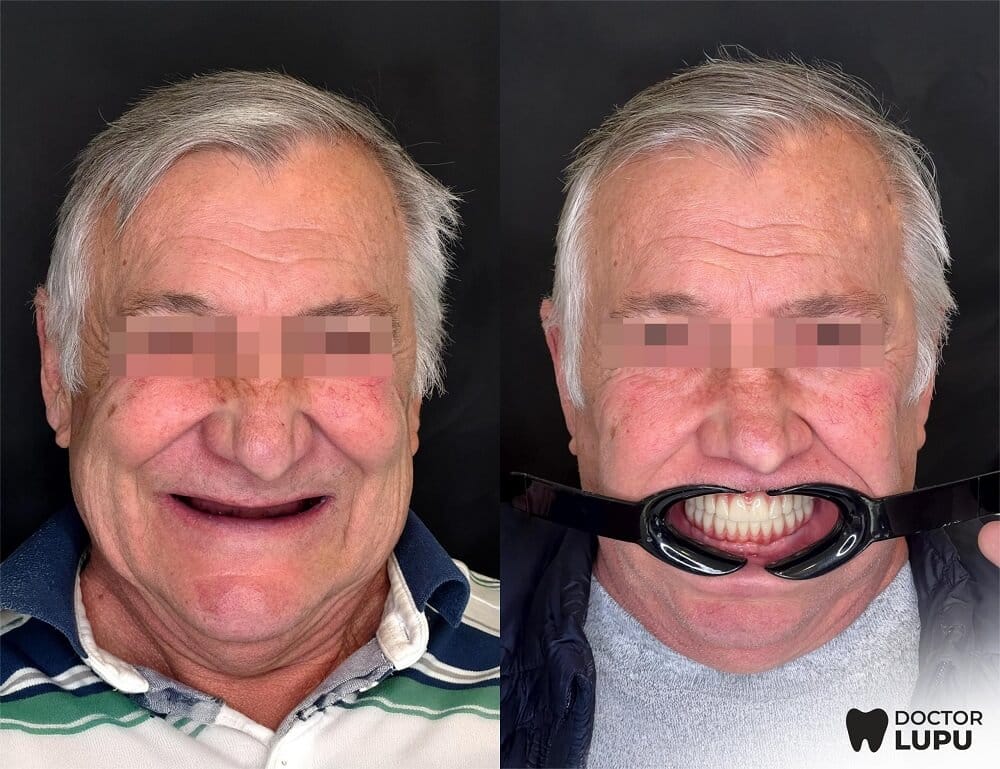 Implant dentar (Caz complex)