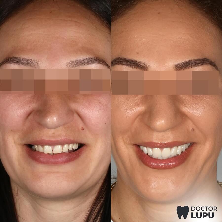Reabilitare estetică dentară, înainte și după tratament - Clinica Dr. Lupu