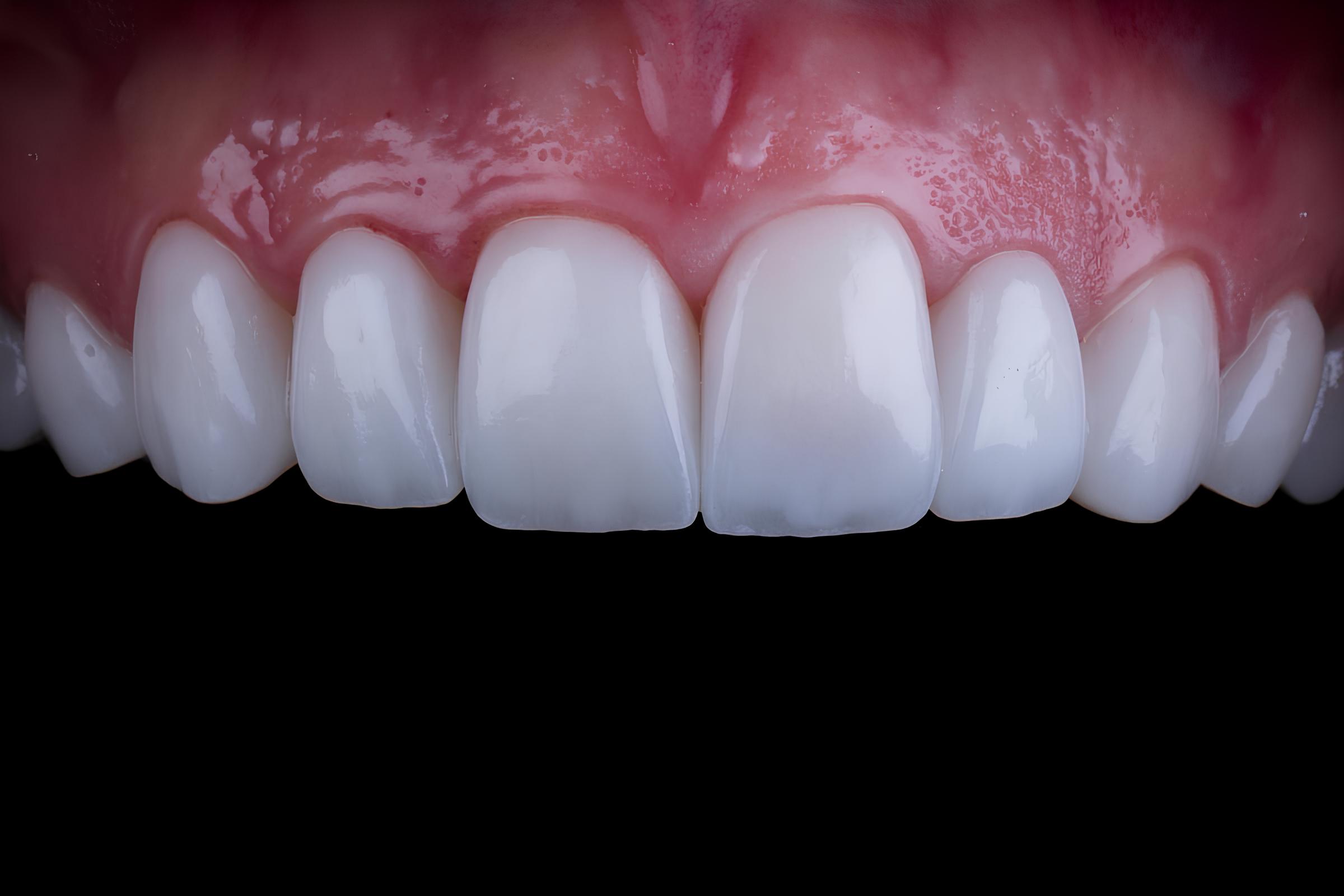 Reabilitare estetică totală cu fațete și coroane ceramice - Dr. Lupu