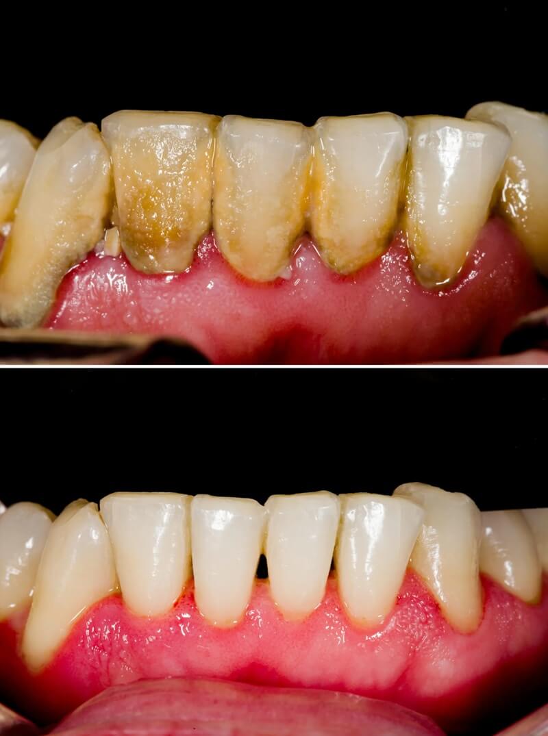 Rezultatul unei igienizări dentare profesionale