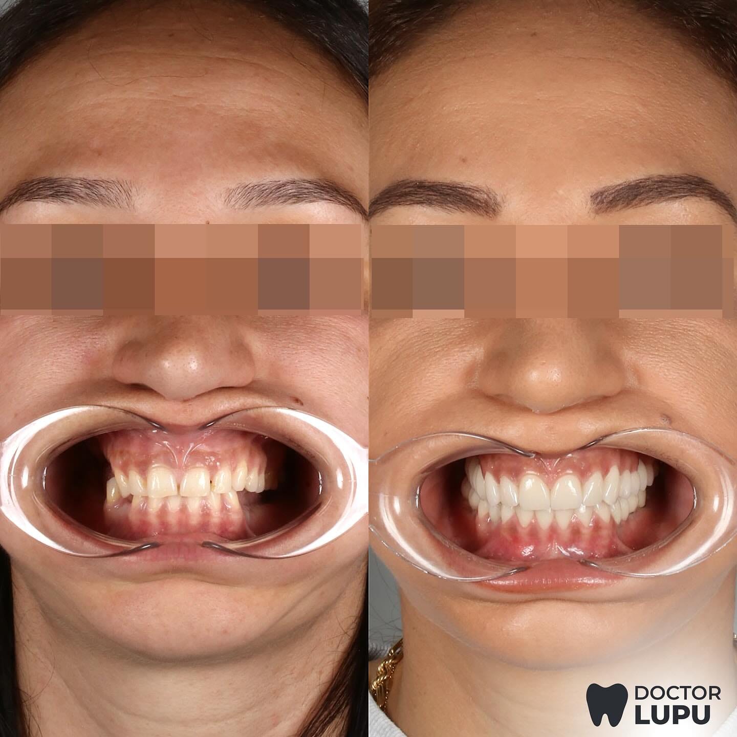 Transformare estetică completă a zâmbetului înainte și după tratament
