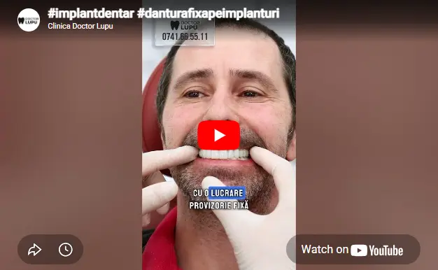#implantdentar #danturafixapeimplanturi
