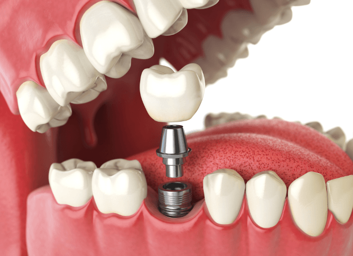 fixare coroana dentară pe implant