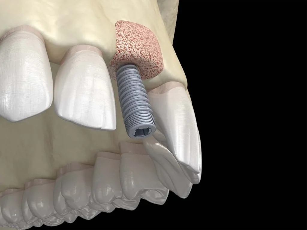Ilustrație cu adiție de os și implant dentar realizate în aceeași intervenție