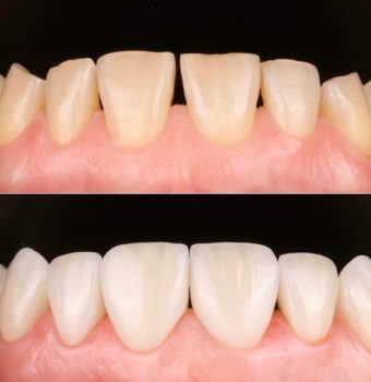 Reconstrucție estetică a zâmbetului cu fațete dentare (înainte și după)