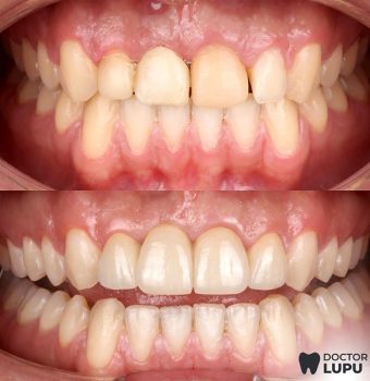 Rezultat estetic obținut cu fațete dentare (înainte și după)