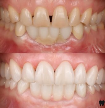 Rezultat estetic obținut cu fațete dentare